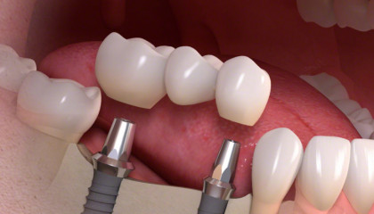 ​Протезирование зубов